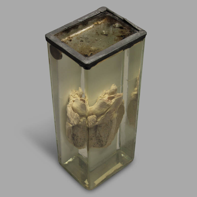 Formalin Preservation of a Human Heart Specimen - Image 2